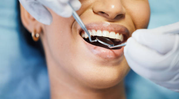 Best Knocked-Out Tooth (Avulsed Tooth) Treatment in Pine Air, FL