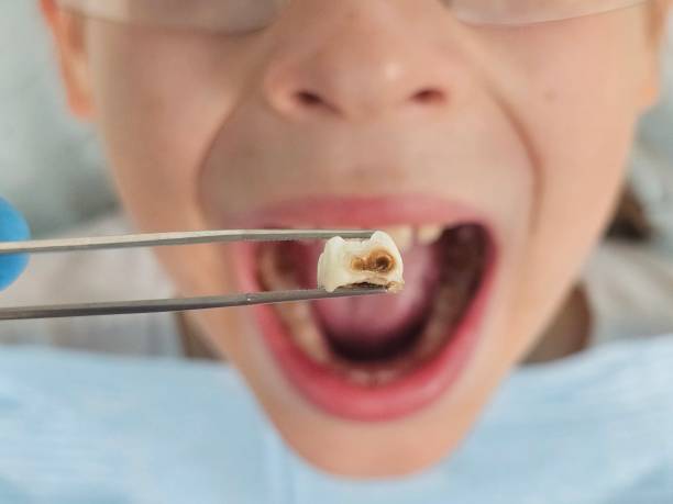 Best Dental Abscess Treatment in Pine Air, FL